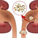 Kidney Stones: Causes, Prevention, and Natural Treatments